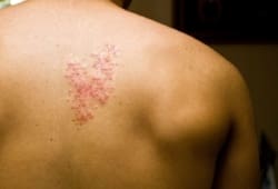 A shingles rash on a man’s back